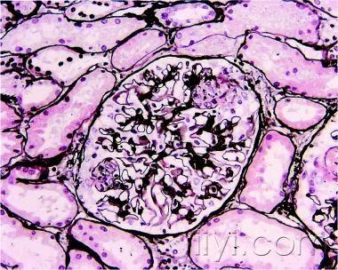 肾小球肾炎病理图片集锦 - 肾脏内科资源版 - 爱爱医