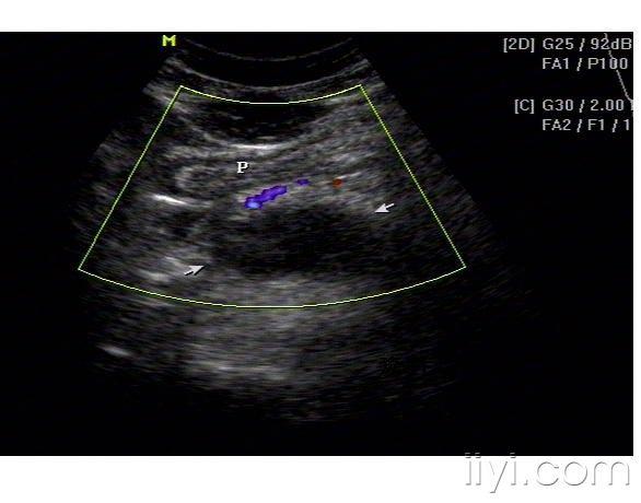 胰腺囊肿 超声医学讨论版 爱爱医医学论坛 爱爱医医学网