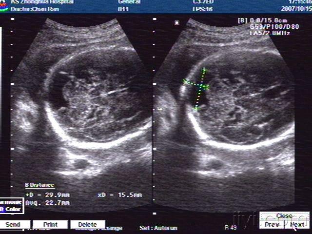 超声检查:胎儿小脑延髓池扩大,余未见明显异常征象(胎心,胸腹部脏器