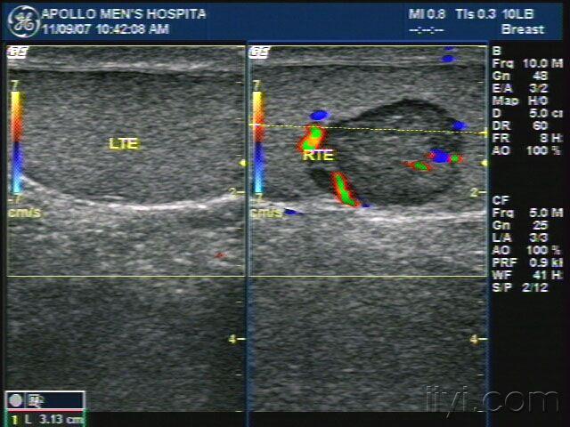 睾丸肿瘤!大家帮忙看一下! - 超声医学讨论版 - 爱爱