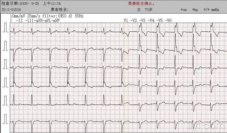 室上性心律失常的qrs形态与右束支型室速相似图片集锦之一(八份图)