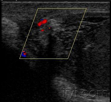 附睾结核 - 超声医学讨论版 - 爱爱医医学论坛-爱爱医