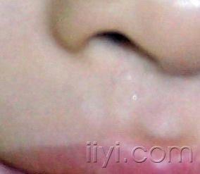 请问这张图片是不是白癜风(有新图)