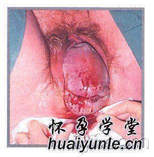 产妇臀位分娩过程<em>图片</em> - 妇产科专业讨论版 - 爱