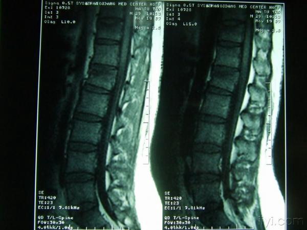 l1椎体压缩性骨折