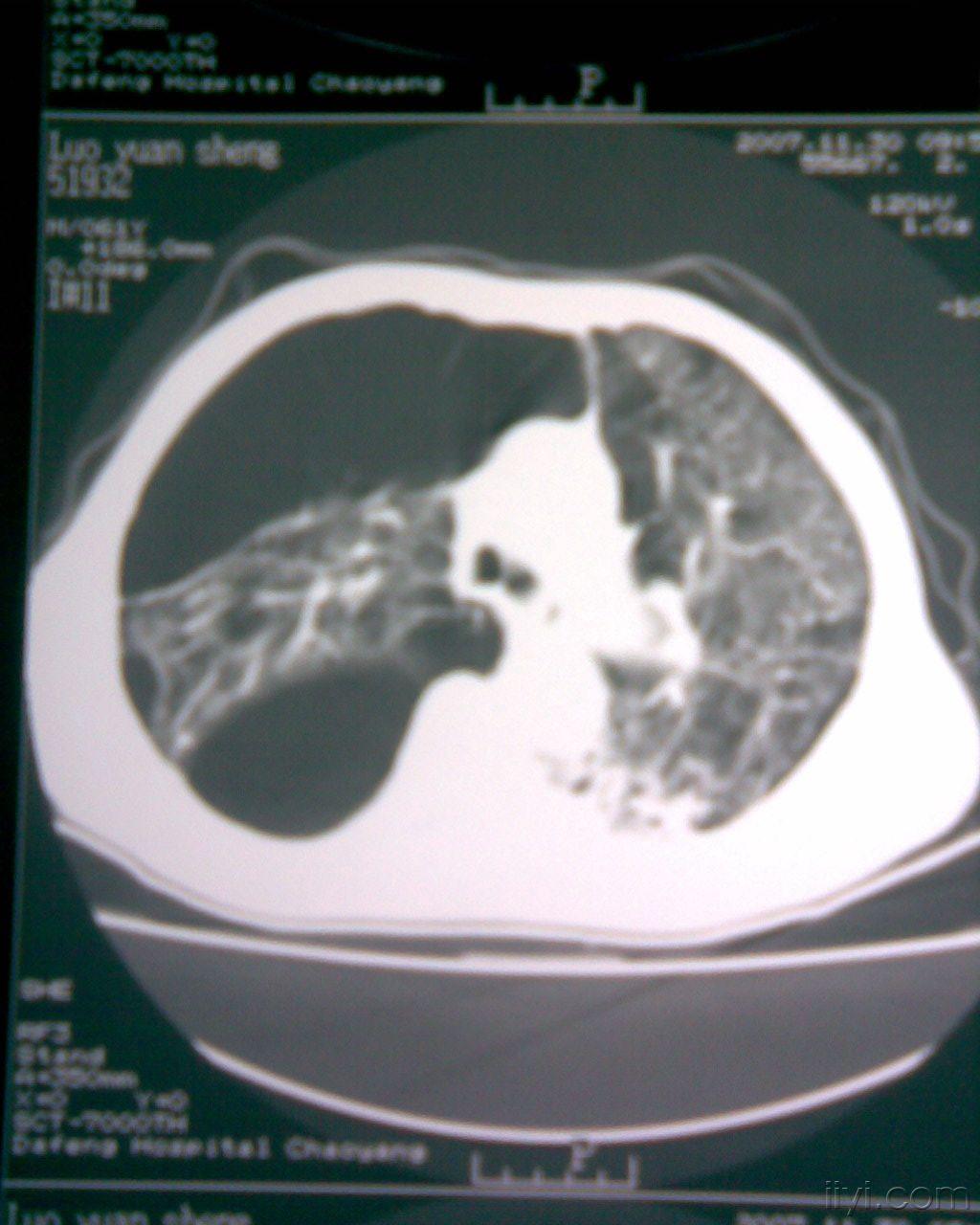 这样的肺大泡,手术预后如何?(附图)