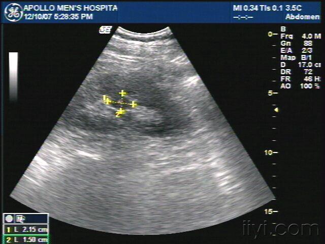 肾内低回声团块!肾柱肥大?