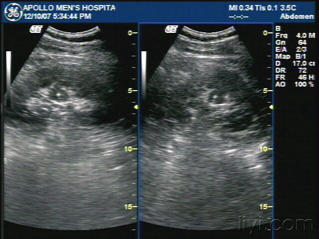肾柱肥大 超声医学讨论版 爱爱医医学论坛 爱爱医医学网
