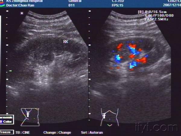 肾内低回声区,是肾柱肥大吗?
