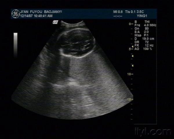 胎儿腹腔内囊性包块第一例