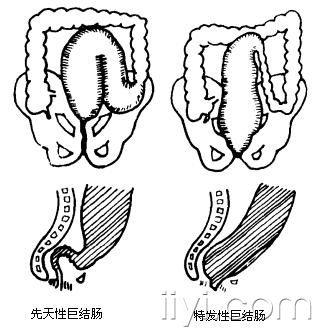 5楼回复eswl3281先天性巨结肠与特发性无张力性巨结肠的鉴别:  先天