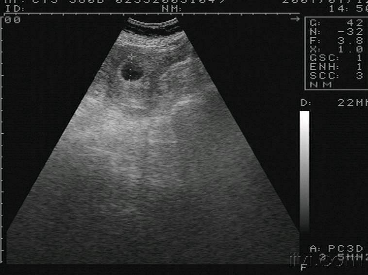 宫外孕典型图 超声医学讨论版 爱爱医医学论坛 爱爱医医学网