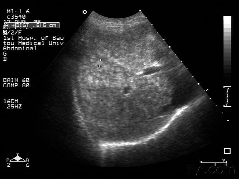 结节性肝硬化 - 超声医学讨论版 - 爱爱医医学论坛