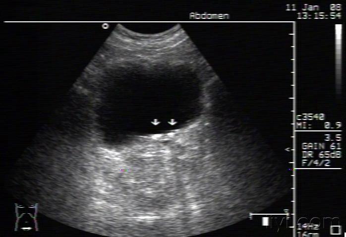 膀胱憩室 - 超声医学讨论版 - 爱爱医医学论坛 - 爱爱医医学网
