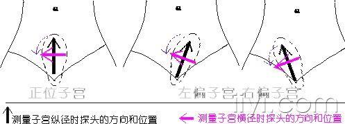 而后横切,显示子宫横断面,探测困难时,可配合