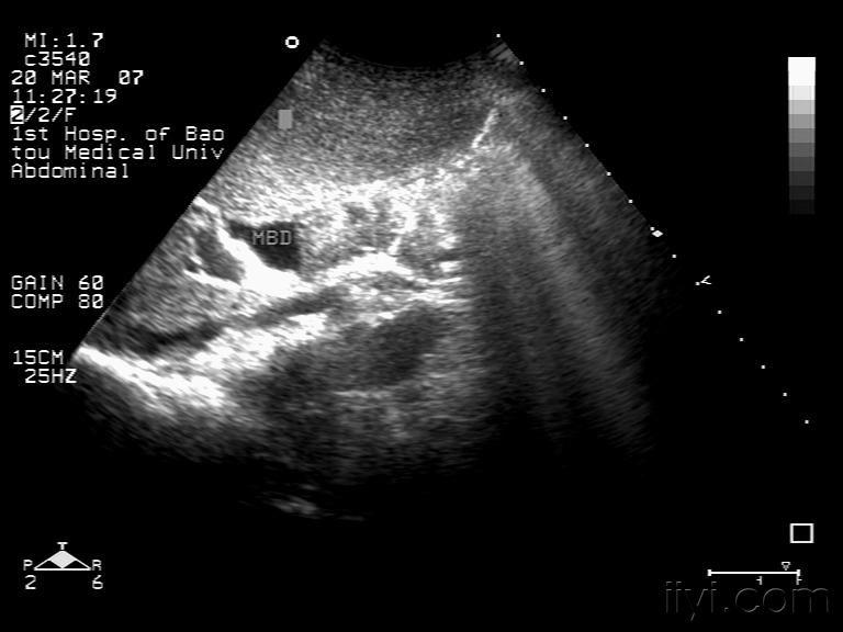胆总管ca - 超声医学讨论版 - 爱爱医医学论坛 - 爱爱
