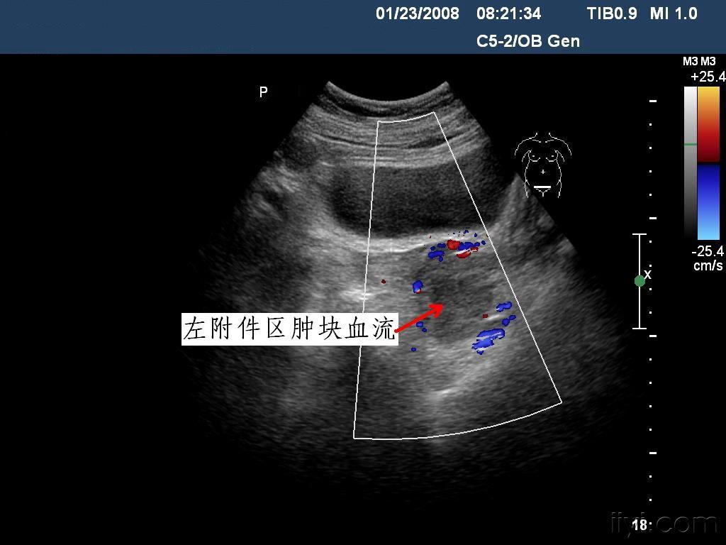 左侧附件区肿块