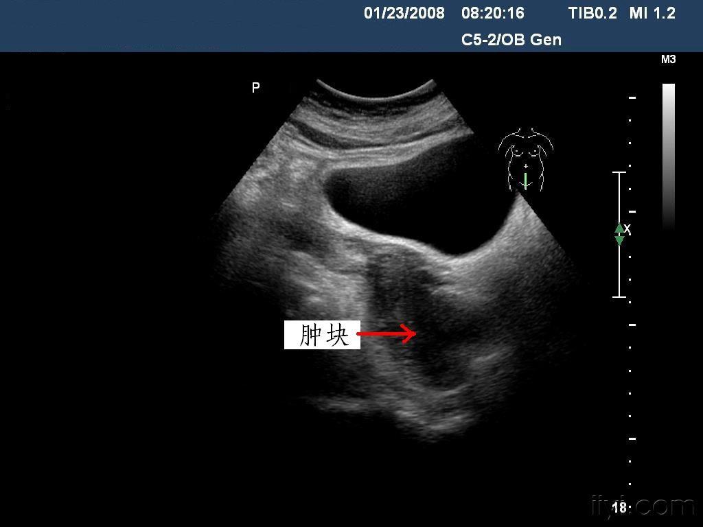 一月前,因阴道流血,到当地一家三甲医院超声检查诊断为"阔韧带肌瘤".