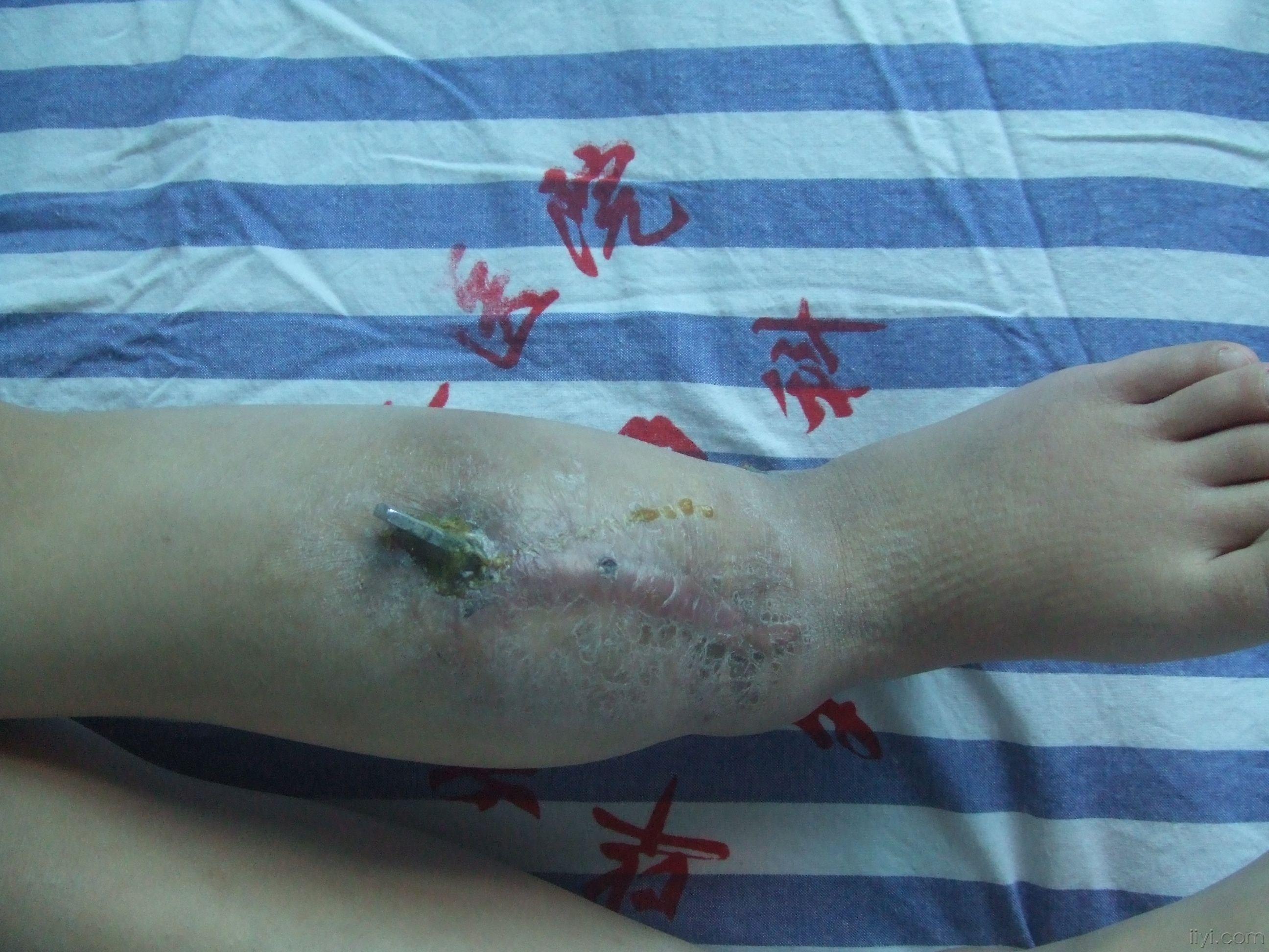 胫腓骨骨折术后钢板外露-----已做手术