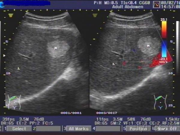 肝血管瘤 - 超声医学讨论版 - 爱爱医医学论坛 - 爱爱