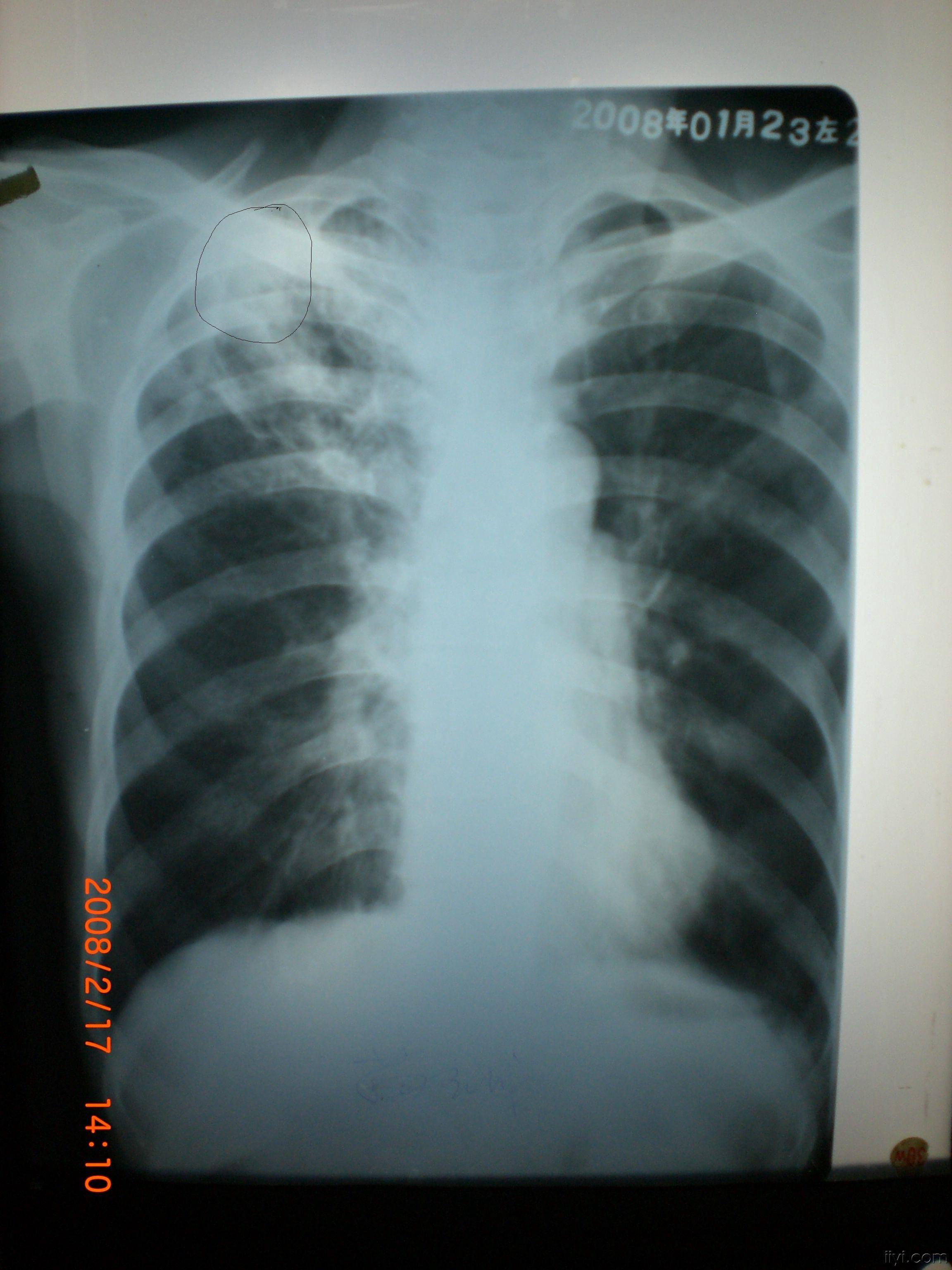 lol: )结合上肺较均匀密度高,我想肺结核肯定有的,但是应该想到占位