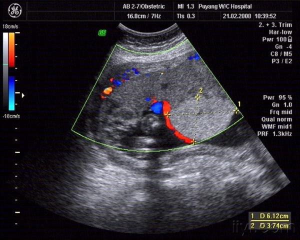 又一例胎盘部位异常回声 - 超声医学讨论版 - 爱爱医