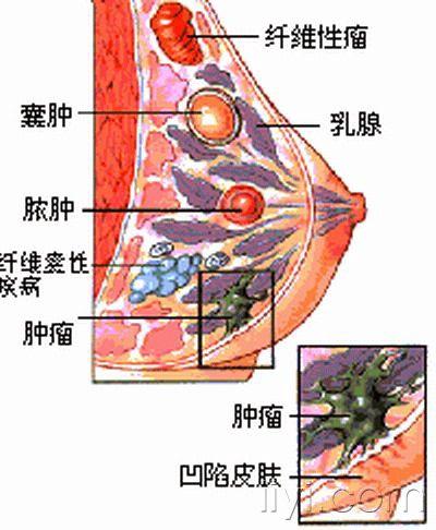 8楼回复杨小军乳房纤维瘤好发于20∽25岁青年妇女,约占乳房肿瘤的10%