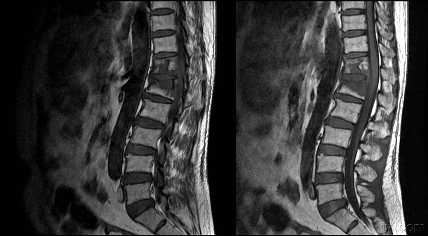 月后腰痛加剧,向下肢放射,无发热,盗汗及消瘦,患者否认既往有结核病史