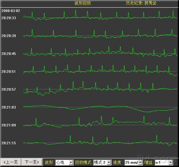 分析一个患者的心电变化