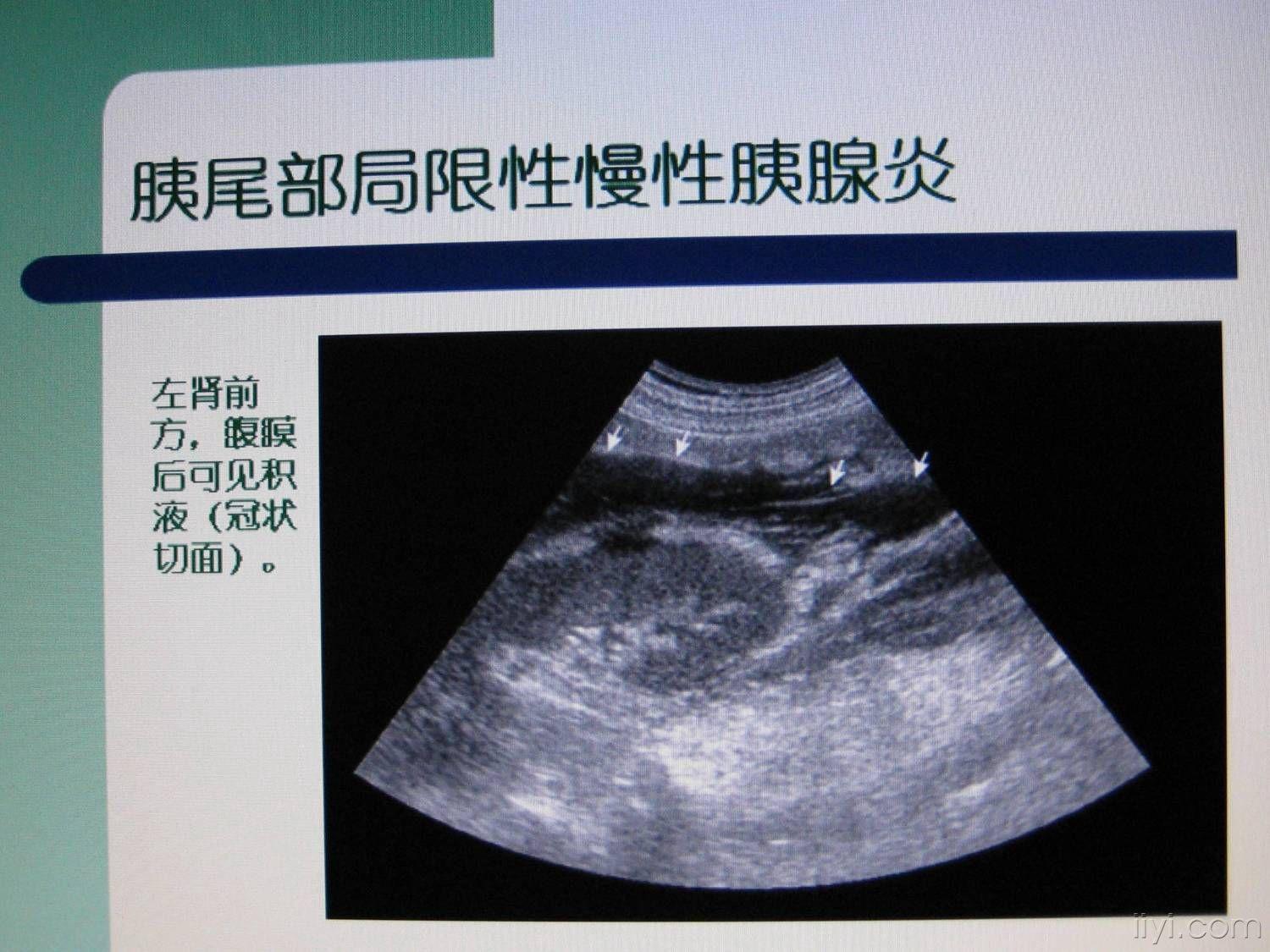 胰腺炎超声诊断