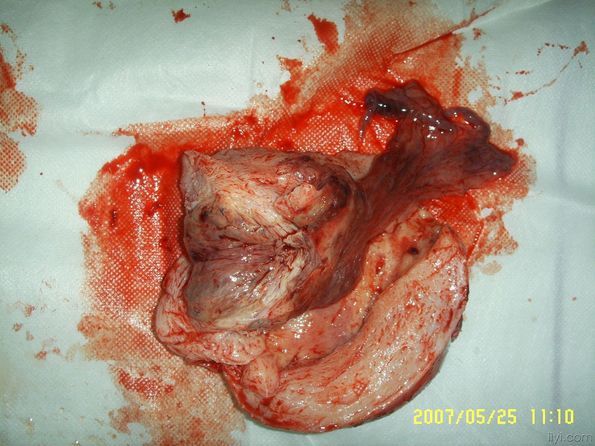 子宫肌瘤;2.宫腔感染;3.子宫内膜病变?4.中度贫血.