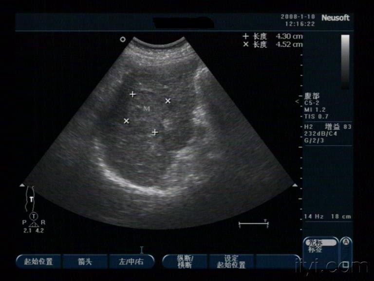 超声所见:肝右叶实质性包块,门静脉内见高回声团块.