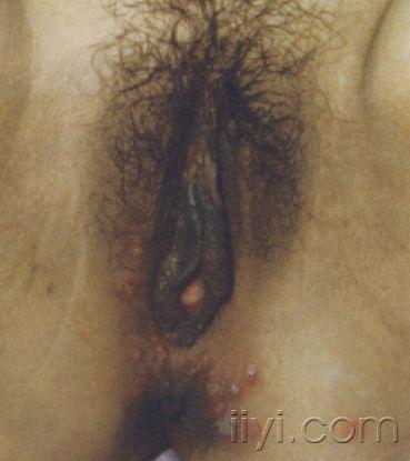 [专家讲座1]常见 皮肤病 的诊疗(刘全忠教授主讲