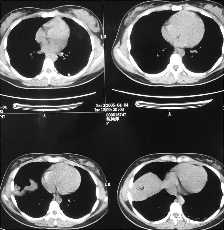 查体发现右下肺占位1周 2005/3/23(铁路总医院)胸部ct:由右肺下膈面
