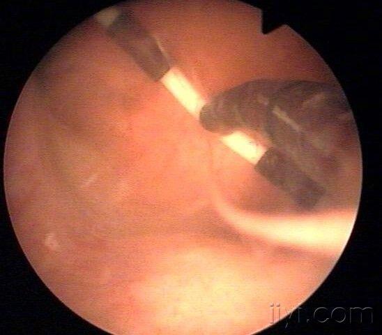 [图片] 经典宫腔镜图片