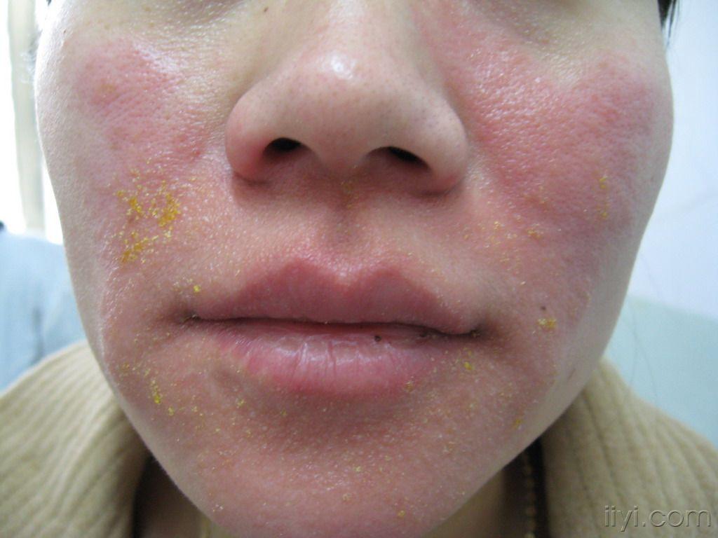 糠秕孢子菌毛囊炎  3. 皮肌炎(面部红斑)  4. 染发皮炎
