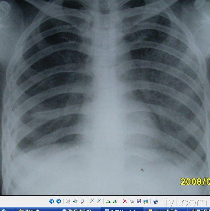 几个典型的肺部片子,大家共同分享!