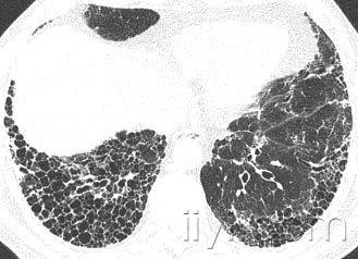 21:38:50蜂窝征 病理:蜂窝征代表肺组织的破坏和纤维化,包括大量的囊
