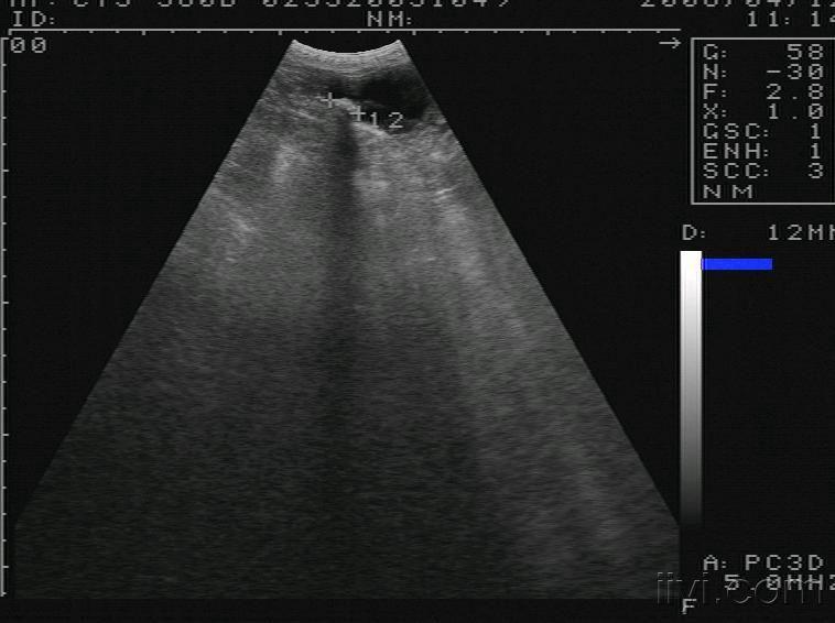 一小毛毛狗的肝硬化伴腹水 - 超声医学讨论版 - 爱爱医医学论坛
