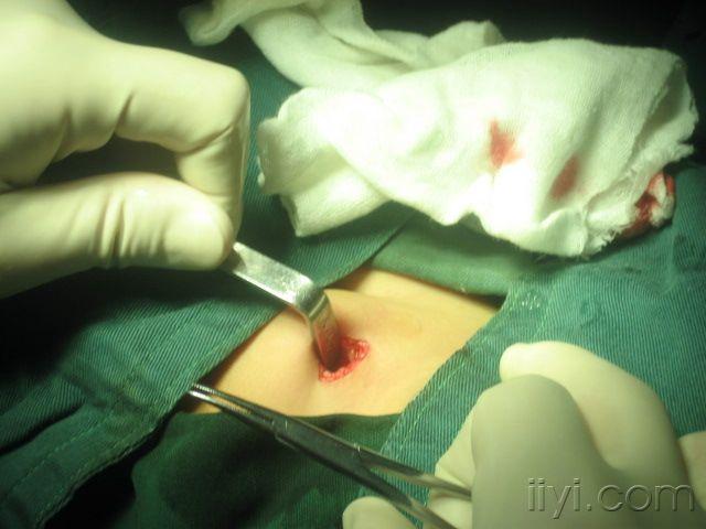 楼主libo0072008-04-13 18:41:36患者,男,2岁,因右侧腹股沟发现一