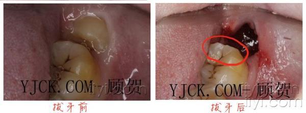 微创拔牙-—图片
