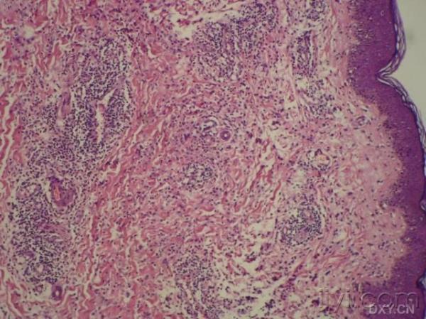 皮疹及病理均支持 莱姆 病