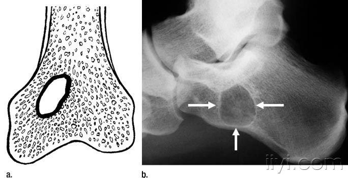 骨肿瘤影像学诊断————编译自radiology--1楼提供附件,供下载