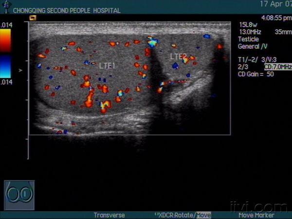 阴囊多睾症声像图 超声医学讨论版 爱爱医医学论坛 爱爱医医学