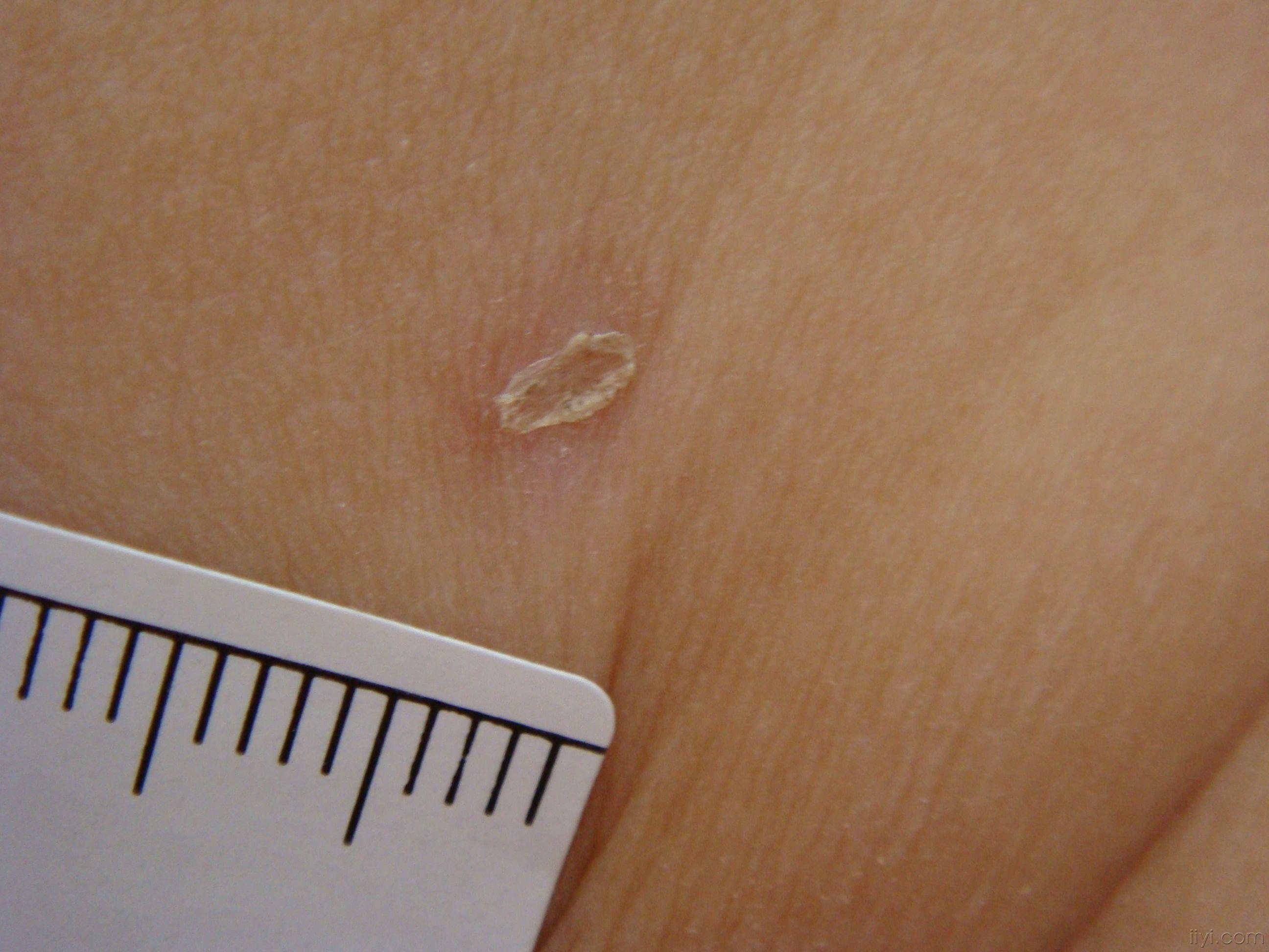 liangyutao2008-05-29 23:39:343月大婴儿,躯干,手背自生后6天起红斑