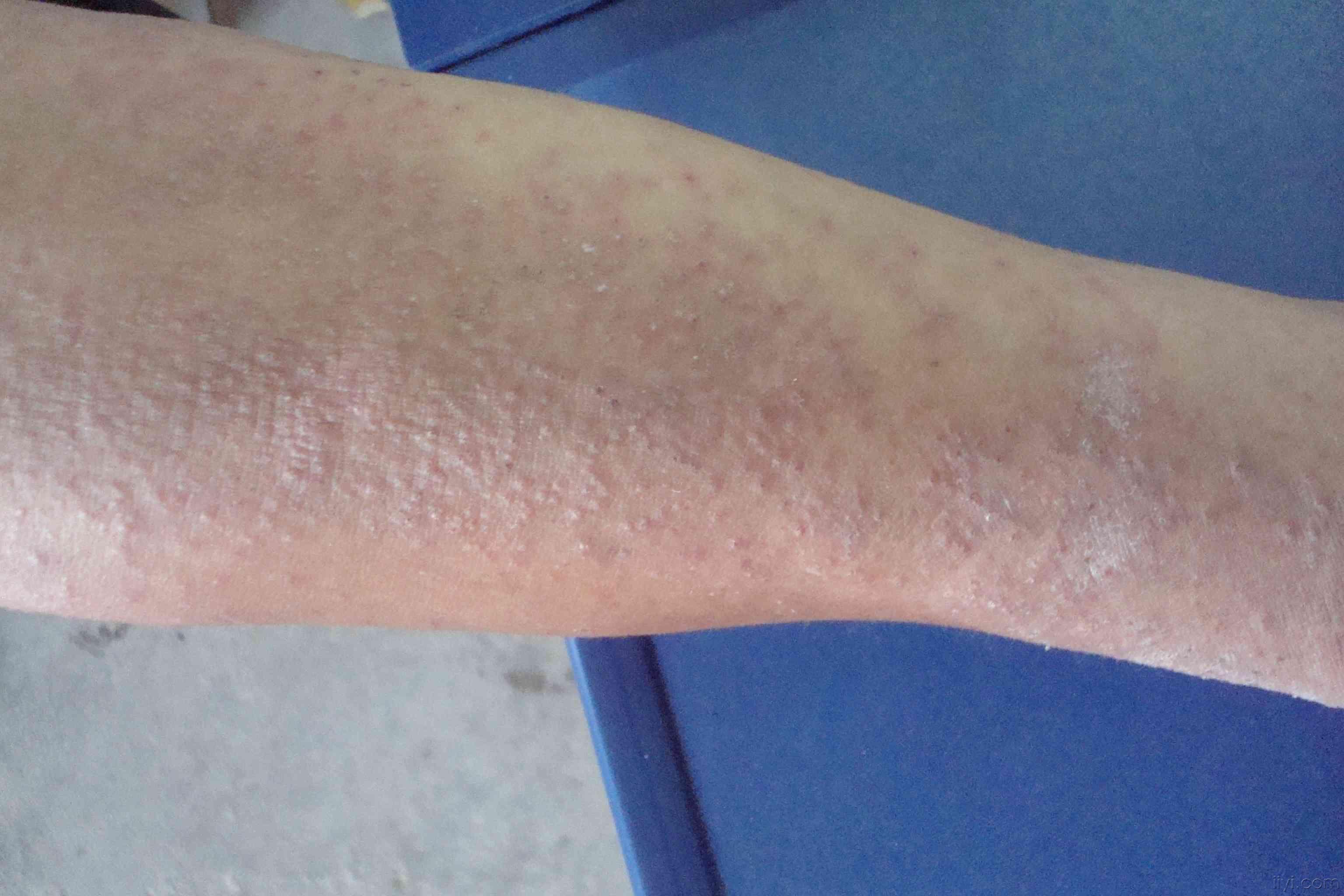 这是不是神经性皮炎
