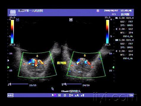 典型前列腺增生症超声图片