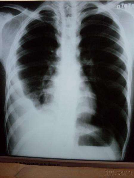 包裹性胸腔积液中医治愈举例