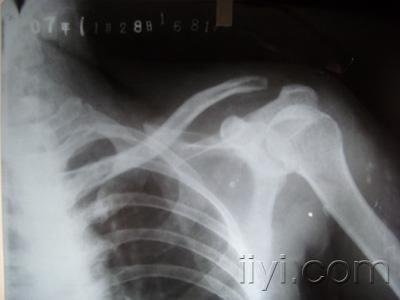 紧急求助,肩锁关节脱位