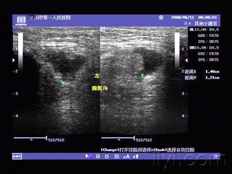 典型腹股沟斜疝声像图片 - 超声医学讨论版 - 爱爱医